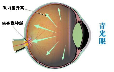 青光眼医保能报销吗 青光眼慢病医保